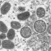 First possible monkeypox case reported in DC