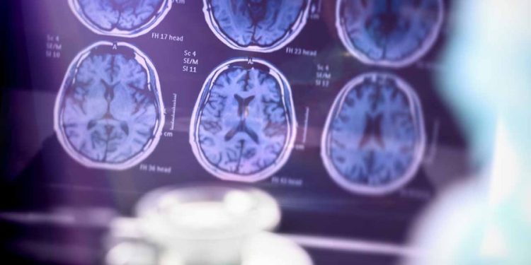 Medicare will remove limits on PET scans used with new Alzheimer’s drugs