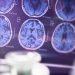 Medicare will remove limits on PET scans used with new Alzheimer’s drugs