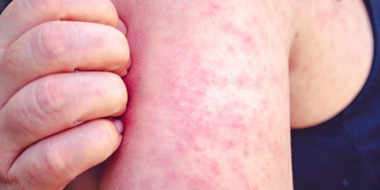 Florida health officials investigate measles outbreak at school