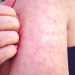 Florida health officials investigate measles outbreak at school
