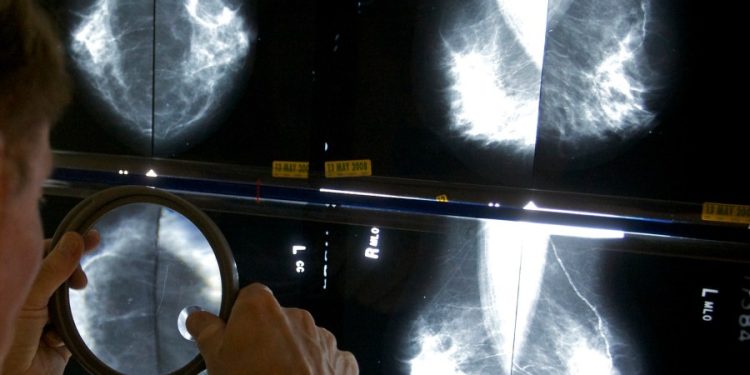 Breast cancer diagnoses ticking up among young women, Asian Americans: Research